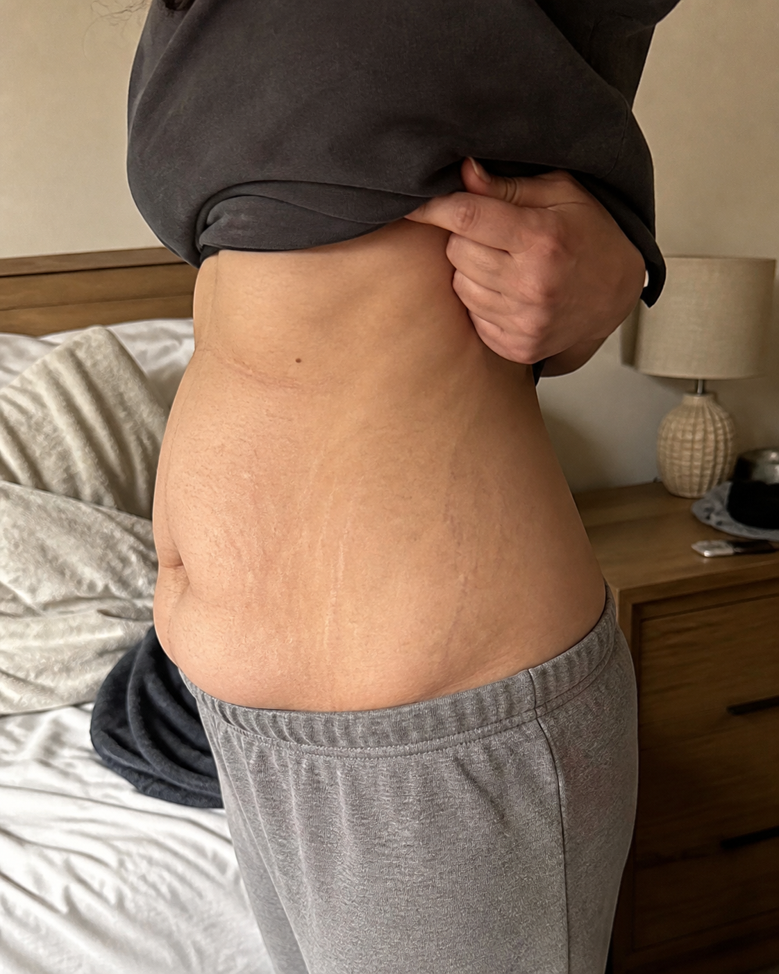 Close side view of an adult postpartum midsection in an ordinary bedroom